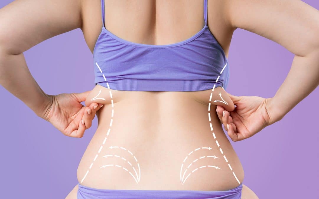 VASER Liposuction in London: Targeting Stubborn Fat, Flanks, and Abdomen