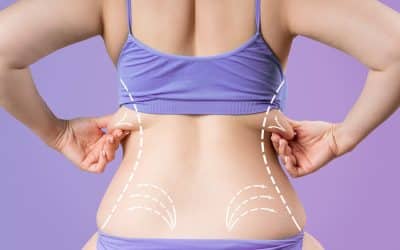 VASER Liposuction in London: Targeting Stubborn Fat, Flanks, and Abdomen
