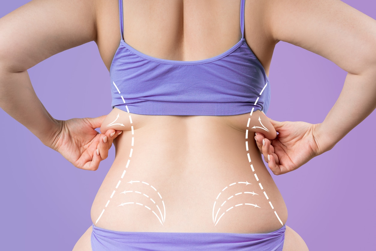 VASER Liposuction in London: Targeting Stubborn Fat, Flanks, and Abdomen